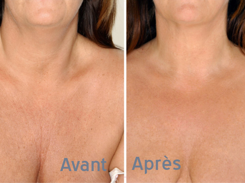 poitrine femme lissage jeune - traitement anti age