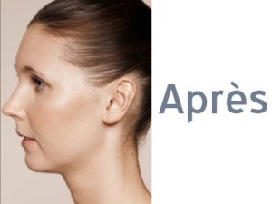 visage profil jeune peau - peeling visage