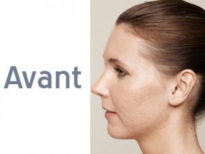 visage profil peau soin - injection acide hyaluronique