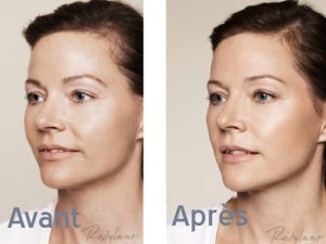 visage médecine esthétique - medecine esthetique visage